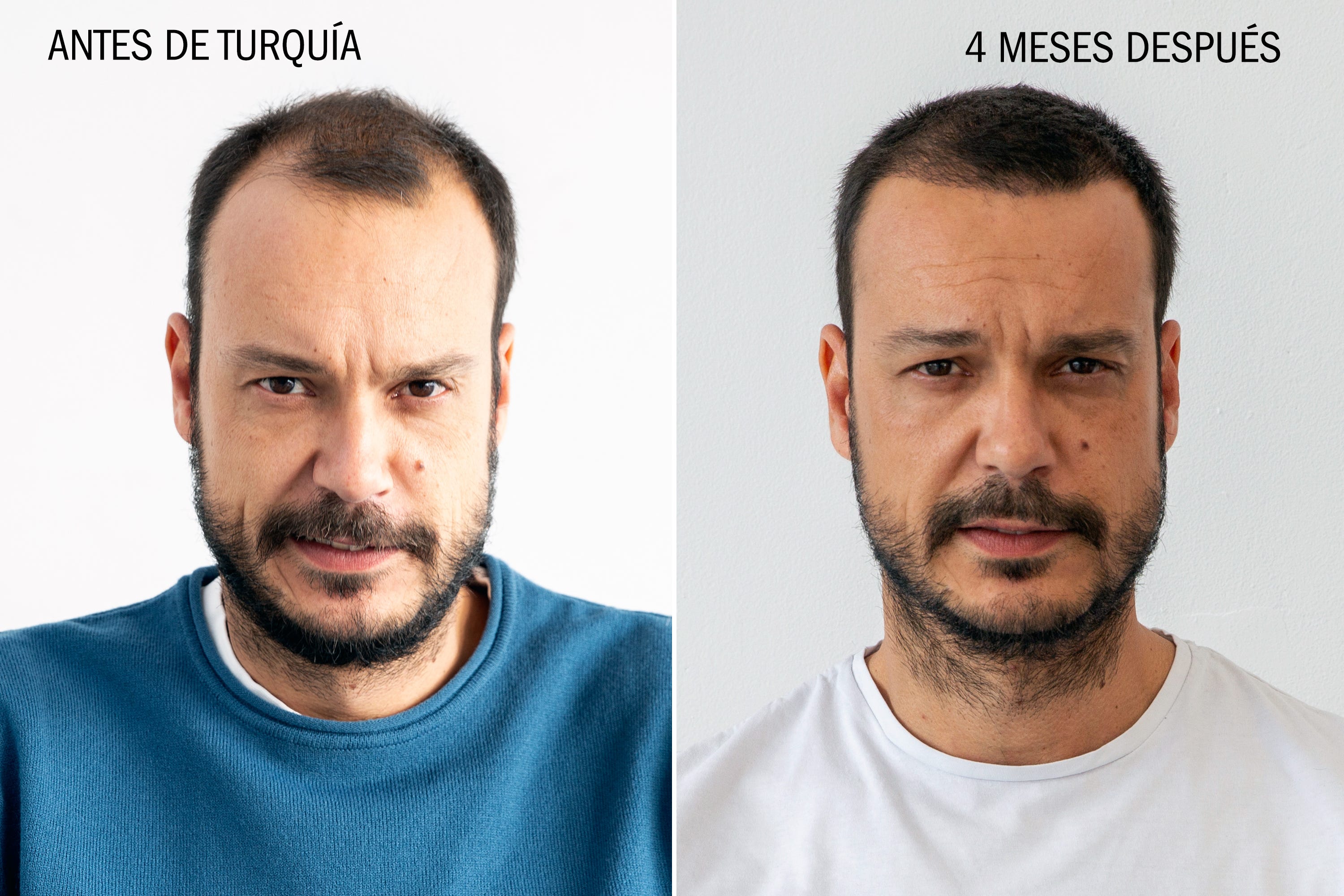 Precio implante capilar turquia